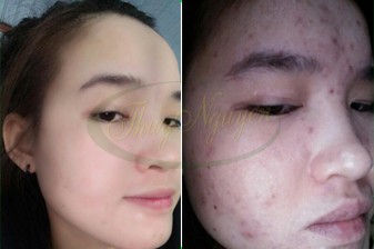 Cách trị mụn đầu đen, mụn cám, mụn mũ hiệu quả của khách hàng - MSKH: TN1666